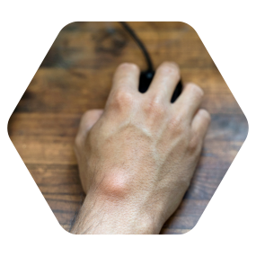 Best lipoma treatment in hyderabad cupping therapy for lipoma hijama for lipoma