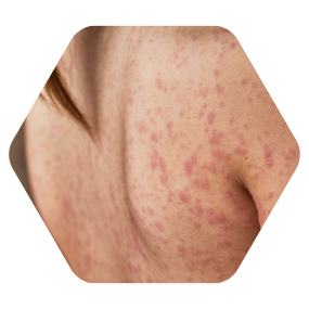 Best pimples treatment in hyderabad best skin specialist in hyderabad for pimples cupping therapy for pimples hijama for pimples hijama therapy for pimples pimples treatment in hyderabad best skin specialist in hyderabad for fungal infection best doctor for fungal infection in hyderabad