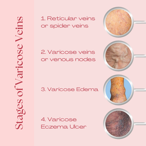Best doctor for varicose veins in hyderabad, best doctor for varicose veins in india, best doctor for varicose veins near me, best treatment for varicose vein, best treatments for varicose veins, best varicose veins doctor in hyderabad, cure for varicose vein, cure for varicose veins, cure of varicose veins, doctor for varicose vein, hijama for varicose veins, hijama treatment for varicose veins, hijama varicose veins, how to treat varicose veins, is cupping therapy good for varicose veins, non surgical treatment for varicose veins, relieving varicose vein pain, treatment for varicose eczema, varicose doctor, varicose eczema treatment, varicose vein clinic hyderabad telangana, varicose vein doctors in hyderabad, varicose vein in telugu, varicose vein specialist in hyderabad, varicose vein treatment hyderabad, varicose vein treatment in hyderabad, varicose vein ulcer, varicose veins bodybuilding, varicose veins clinic hyderabad, varicose veins clinic in hyderabad, varicose veins doctor in hyderabad, varicose veins doctor in hyderabad, varicose veins doctors in hyderabad, varicose veins hands, varicose veins hospital in hyderabad, varicose veins hospital in hyderabad, varicose veins removal, varicose veins specialist doctor in hyderabad, varicose veins specialist doctor in hyderabad, varicose veins specialist in hyderabad, varicose veins specialist in hyderabad, varicose veins treatment hospitals in hyderabad, what are the causes of varicose veins, why varicose veins form