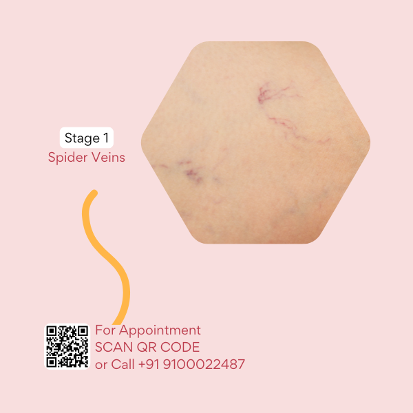 Best doctor for varicose veins in hyderabad, best doctor for varicose veins in india, best doctor for varicose veins near me, best treatment for varicose vein, best treatments for varicose veins, best varicose veins doctor in hyderabad, cure for varicose vein, cure for varicose veins, cure of varicose veins, doctor for varicose vein, hijama for varicose veins, hijama treatment for varicose veins, hijama varicose veins, how to treat varicose veins, is cupping therapy good for varicose veins, non surgical treatment for varicose veins, relieving varicose vein pain, treatment for varicose eczema, varicose doctor, varicose eczema treatment, varicose vein clinic hyderabad telangana, varicose vein doctors in hyderabad, varicose vein in telugu, varicose vein specialist in hyderabad, varicose vein treatment hyderabad, varicose vein treatment in hyderabad, varicose vein ulcer, varicose veins bodybuilding, varicose veins clinic hyderabad, varicose veins clinic in hyderabad, varicose veins doctor in hyderabad, varicose veins doctor in hyderabad, varicose veins doctors in hyderabad, varicose veins hands, varicose veins hospital in hyderabad, varicose veins hospital in hyderabad, varicose veins removal, varicose veins specialist doctor in hyderabad, varicose veins specialist doctor in hyderabad, varicose veins specialist in hyderabad, varicose veins specialist in hyderabad, varicose veins treatment hospitals in hyderabad, what are the causes of varicose veins, why varicose veins form