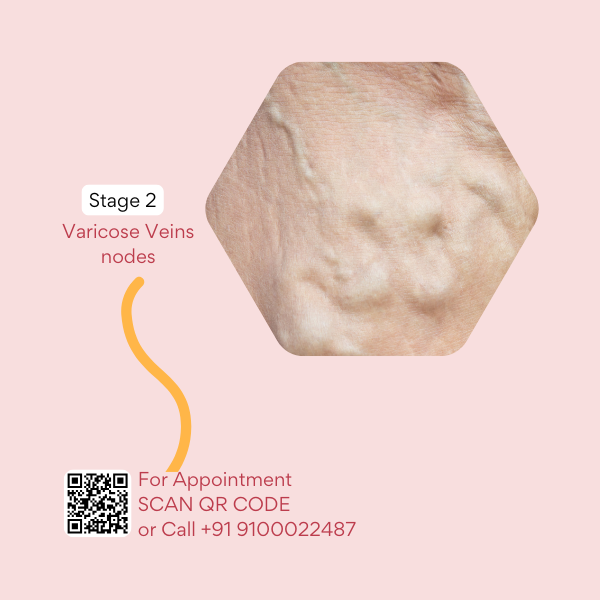 Best doctor for varicose veins in hyderabad, best doctor for varicose veins in india, best doctor for varicose veins near me, best treatment for varicose vein, best treatments for varicose veins, best varicose veins doctor in hyderabad, cure for varicose vein, cure for varicose veins, cure of varicose veins, doctor for varicose vein, hijama for varicose veins, hijama treatment for varicose veins, hijama varicose veins, how to treat varicose veins, is cupping therapy good for varicose veins, non surgical treatment for varicose veins, relieving varicose vein pain, treatment for varicose eczema, varicose doctor, varicose eczema treatment, varicose vein clinic hyderabad telangana, varicose vein doctors in hyderabad, varicose vein in telugu, varicose vein specialist in hyderabad, varicose vein treatment hyderabad, varicose vein treatment in hyderabad, varicose vein ulcer, varicose veins bodybuilding, varicose veins clinic hyderabad, varicose veins clinic in hyderabad, varicose veins doctor in hyderabad, varicose veins doctor in hyderabad, varicose veins doctors in hyderabad, varicose veins hands, varicose veins hospital in hyderabad, varicose veins hospital in hyderabad, varicose veins removal, varicose veins specialist doctor in hyderabad, varicose veins specialist doctor in hyderabad, varicose veins specialist in hyderabad, varicose veins specialist in hyderabad, varicose veins treatment hospitals in hyderabad, what are the causes of varicose veins, why varicose veins form