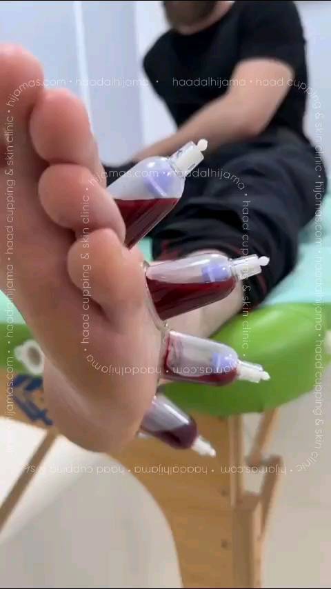 Knee pain natural treatment natural knee pain treatment cupping on knee knee joint pain treatment in hyderabad cupping knee pain cupping therapy knee pain knee pain treatment hyderabad