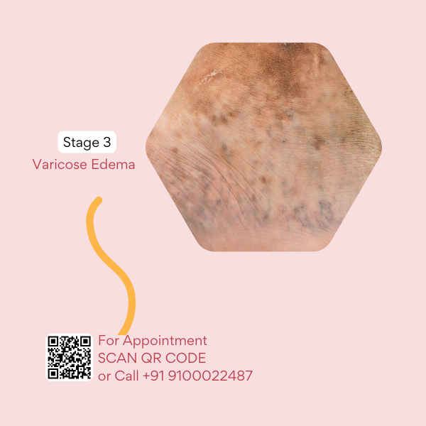 Best doctor for varicose veins in hyderabad, best doctor for varicose veins in india, best doctor for varicose veins near me, best treatment for varicose vein, best treatments for varicose veins, best varicose veins doctor in hyderabad, cure for varicose vein, cure for varicose veins, cure of varicose veins, doctor for varicose vein, hijama for varicose veins, hijama treatment for varicose veins, hijama varicose veins, how to treat varicose veins, is cupping therapy good for varicose veins, non surgical treatment for varicose veins, relieving varicose vein pain, treatment for varicose eczema, varicose doctor, varicose eczema treatment, varicose vein clinic hyderabad telangana, varicose vein doctors in hyderabad, varicose vein in telugu, varicose vein specialist in hyderabad, varicose vein treatment hyderabad, varicose vein treatment in hyderabad, varicose vein ulcer, varicose veins bodybuilding, varicose veins clinic hyderabad, varicose veins clinic in hyderabad, varicose veins doctor in hyderabad, varicose veins doctor in hyderabad, varicose veins doctors in hyderabad, varicose veins hands, varicose veins hospital in hyderabad, varicose veins hospital in hyderabad, varicose veins removal, varicose veins specialist doctor in hyderabad, varicose veins specialist doctor in hyderabad, varicose veins specialist in hyderabad, varicose veins specialist in hyderabad, varicose veins treatment hospitals in hyderabad, what are the causes of varicose veins, why varicose veins form