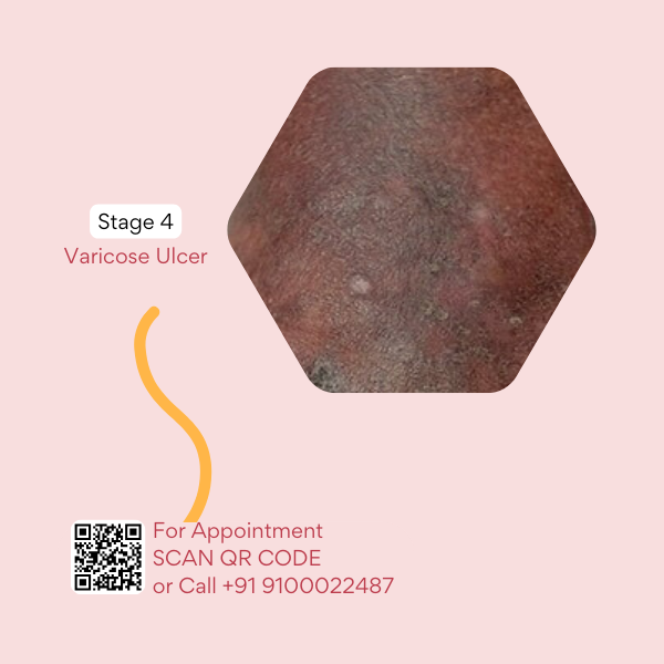 Best doctor for varicose veins in hyderabad, best doctor for varicose veins in india, best doctor for varicose veins near me, best treatment for varicose vein, best treatments for varicose veins, best varicose veins doctor in hyderabad, cure for varicose vein, cure for varicose veins, cure of varicose veins, doctor for varicose vein, hijama for varicose veins, hijama treatment for varicose veins, hijama varicose veins, how to treat varicose veins, is cupping therapy good for varicose veins, non surgical treatment for varicose veins, relieving varicose vein pain, treatment for varicose eczema, varicose doctor, varicose eczema treatment, varicose vein clinic hyderabad telangana, varicose vein doctors in hyderabad, varicose vein in telugu, varicose vein specialist in hyderabad, varicose vein treatment hyderabad, varicose vein treatment in hyderabad, varicose vein ulcer, varicose veins bodybuilding, varicose veins clinic hyderabad, varicose veins clinic in hyderabad, varicose veins doctor in hyderabad, varicose veins doctor in hyderabad, varicose veins doctors in hyderabad, varicose veins hands, varicose veins hospital in hyderabad, varicose veins hospital in hyderabad, varicose veins removal, varicose veins specialist doctor in hyderabad, varicose veins specialist doctor in hyderabad, varicose veins specialist in hyderabad, varicose veins specialist in hyderabad, varicose veins treatment hospitals in hyderabad, what are the causes of varicose veins, why varicose veins form