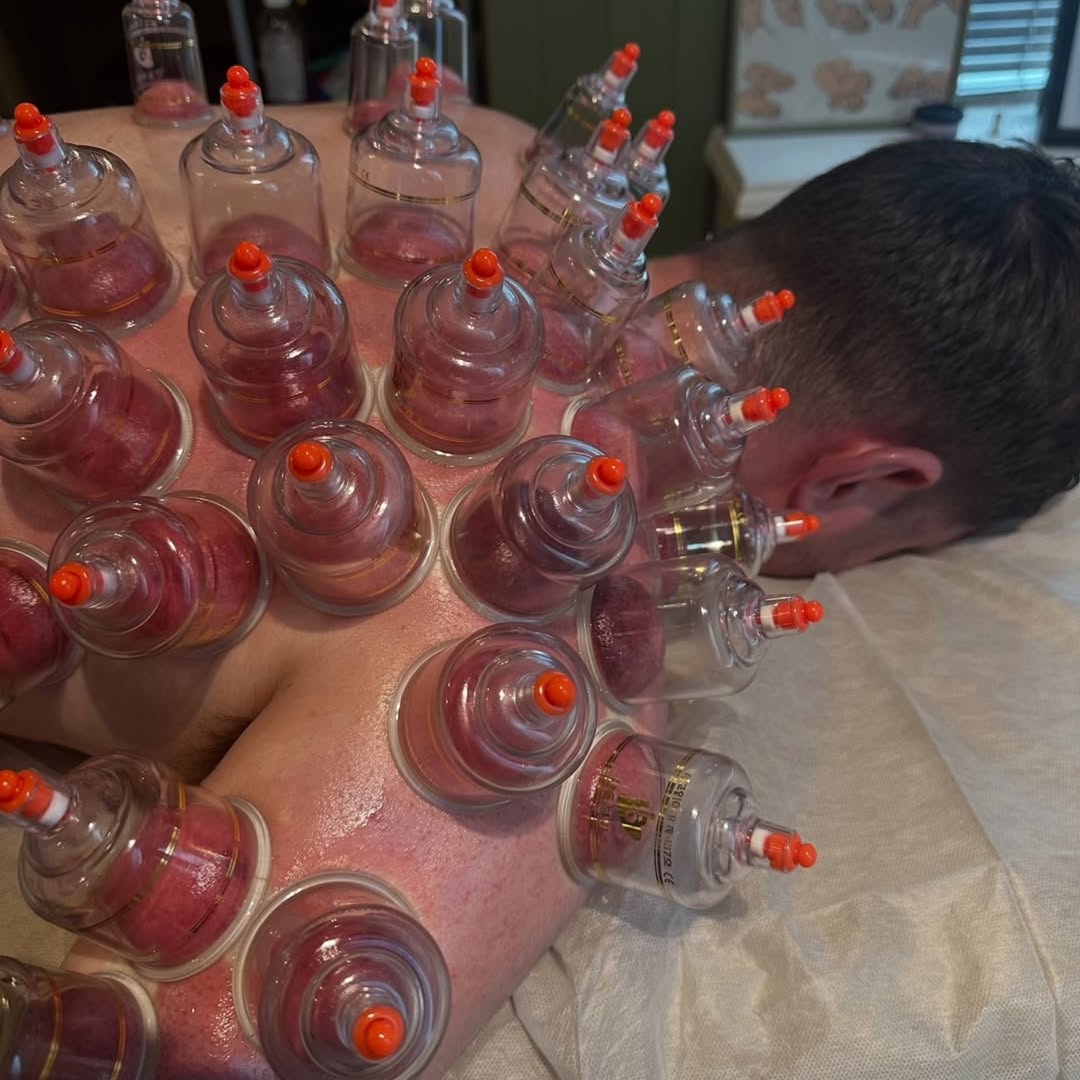 Professional hijama cups placed on a person's back for natural healing at a alhadiv hijama centre hyderabad.