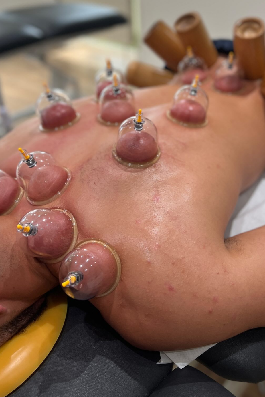 Cupping treatment for back pain specialist in hyderabad alhadiv hijama centre