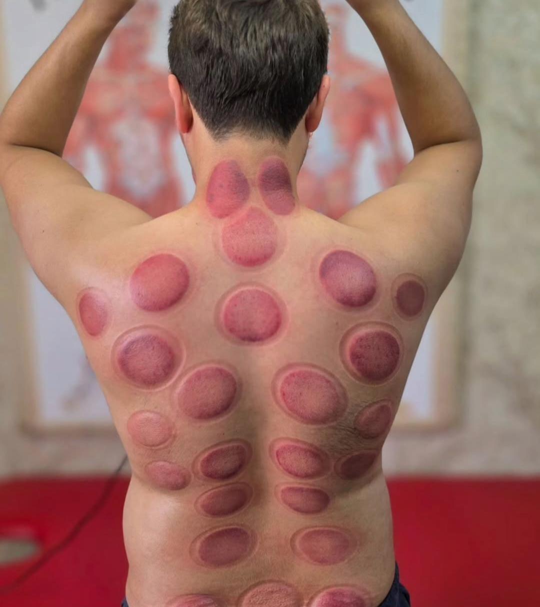 Cupping therapy for low back pain hijama for back pain lower back cupping lower back pain treatment in hyderabad