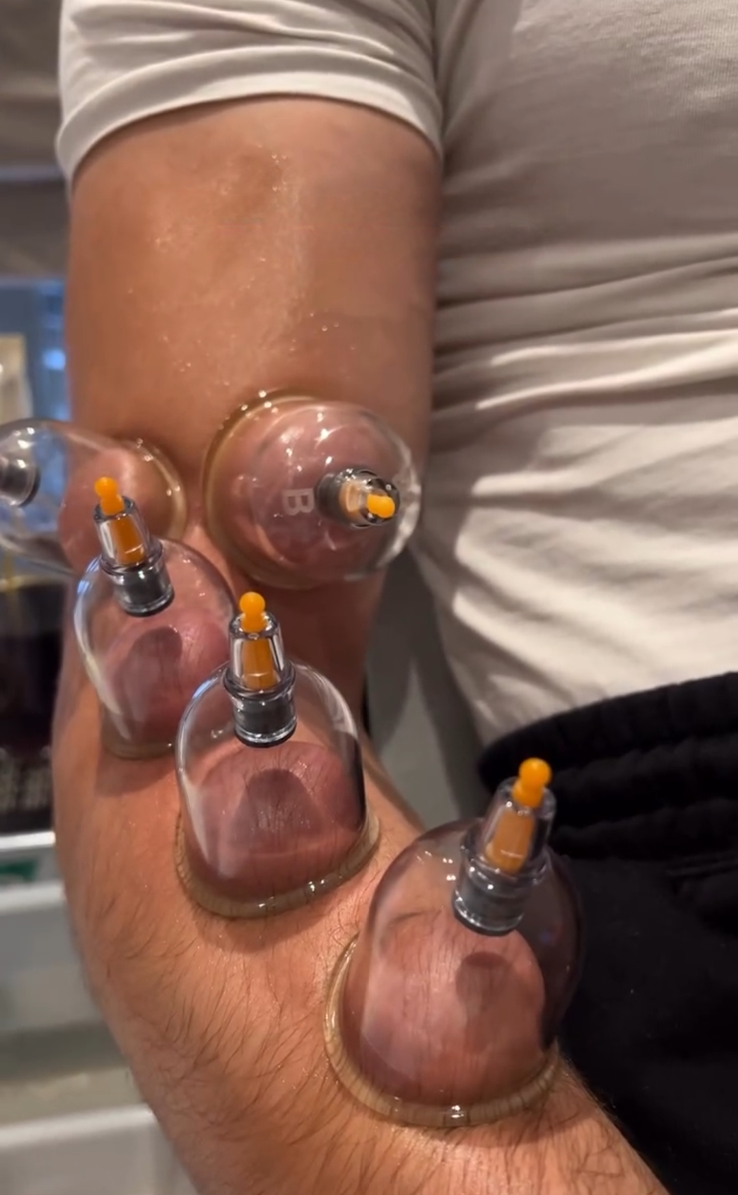 Cupping therapy for tennis elbow treatment in hyderabad