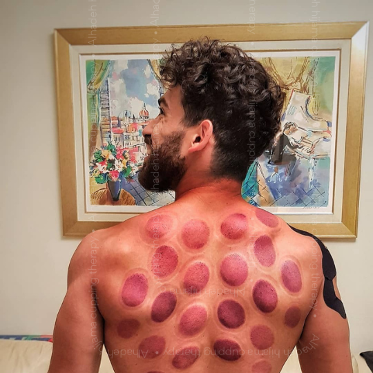 Athlete cupping athlete cupping therapy athletes cupping athletic cupping benefits of cupping for athletes best sports medicine doctors in hyderabad cupping athletes cupping for sports performance cupping sports therapy cupping therapy in sports